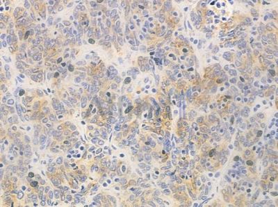 CLK3 Antibody - DF2662 at 1/100 staining human thymoma by IHC-P.