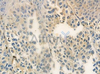 TRIB2 Antibody - DF2692 at 1/100 staining human lung squamous cell carcinoma by IHC-P.