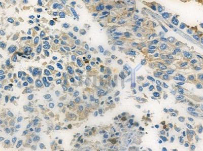 TRIB2 Antibody - DF2692 at 1/100 staining human lung squamous cell carcinoma by IHC-P.