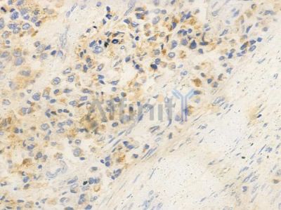 GPR87/GPR95 Antibody - DF2771 at 1/100 staining human prostate carcinoma by IHC-P.