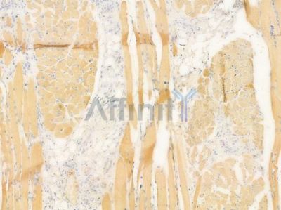 GPR87/GPR95 Antibody - DF2771 at 1/100 staining human tongue carcinoma by IHC-P.