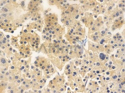 GNRHR2 Antibody - DF2795 at 1/100 staining human hepatocellular carcinoma by IHC-P.