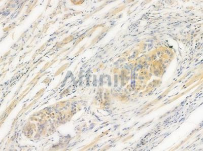 GPR21 Antibody - DF2802 at 1/100 staining human tongue carcinoma by IHC-P.