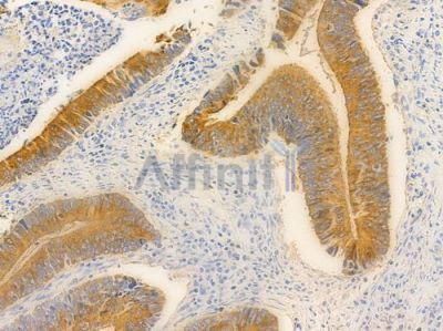 GPR39 Antibody - DF2805 at 1/100 staining human colon carcinoma by IHC-P.