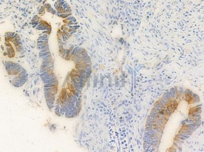GPR39 Antibody - DF2805 at 1/100 staining human colon carcinoma by IHC-P.