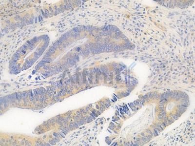 GPR45 Antibody - DF2808 at 1/100 staining human colon carcinoma by IHC-P.