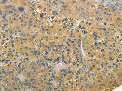 NMUR2 Antibody - DF2821 at 1/100 staining human hepatocellular carcinoma by IHC-P.