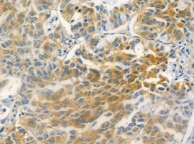 OR4C45 Antibody - DF2826 at 1/100 staining human lung squamous cell carcinoma by IHC-P.
