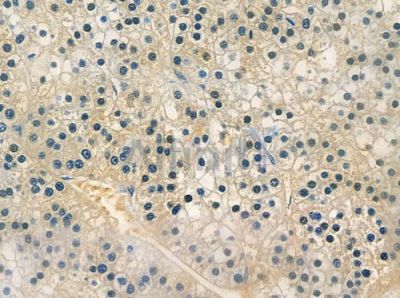 OR4C45 Antibody - DF2826 at 1/100 staining human pancreatic carcinoma by IHC-P.