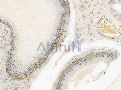 OR4F3/4F21 Antibody - DF2827 at 1/100 staining human testicular cancer by IHC-P.