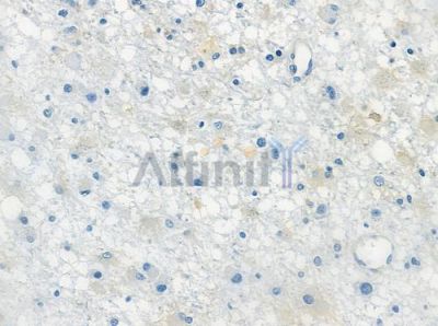 OR51L1 Antibody - DF2828 at 1/100 staining human astrocytoma by IHC-P.