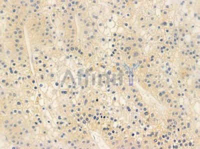 OR6C75 Antibody - DF2832 at 1/100 staining human hepatocellular carcinoma by IHC-P.