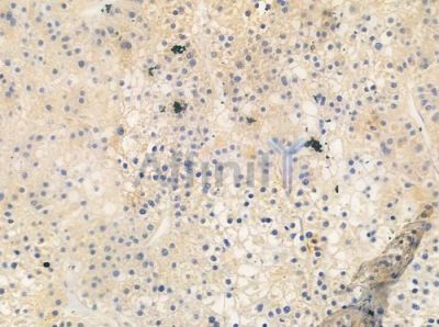 OR10Q1 Antibody - DF2835 at 1/100 staining human hepatocellular carcinoma by IHC-P.