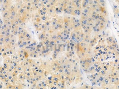 OR1L4/1L6 Antibody - DF2844 at 1/100 staining human pancreatic carcinoma by IHC-P.