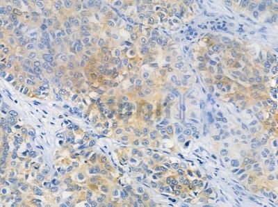 OR1L4/1L6 Antibody - DF2844 at 1/100 staining human lung squamous cell carcinoma by IHC-P.
