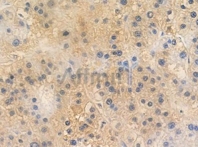 OR2A12 Antibody - DF2845 at 1/100 staining human hepatocellular carcinoma by IHC-P.