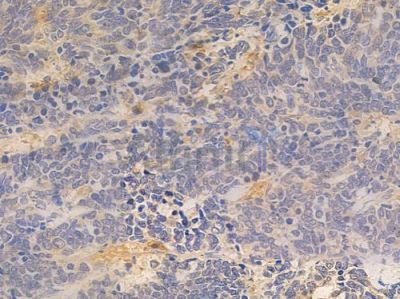 TLR9 Antibody - DF2970 at 1/100 staining human small cell lung carcinoma by IHC-P.