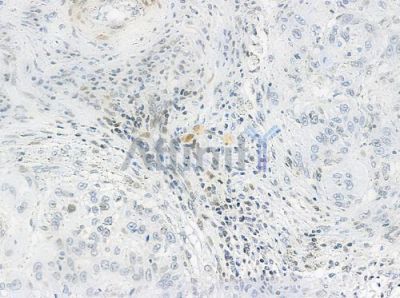 Phospho-RSK2 (Tyr529) Antibody - DF2976 at 1/100 staining human tongue carcinoma by IHC-P.