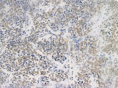 Phospho-RSK2 (Tyr529) Antibody - DF2976 at 1/100 staining human thymoma by IHC-P.