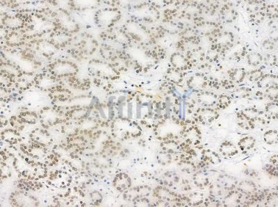 Phospho-RSK2 (Tyr529) Antibody - DF2976 at 1/100 staining human renal cell carcinoma by IHC-P.