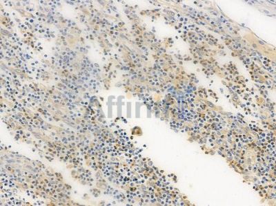 Phospho-Beclin 1 (Ser93/Ser96) Antibody - DF2983 at 1/100 staining human colon carcinoma by IHC-P.