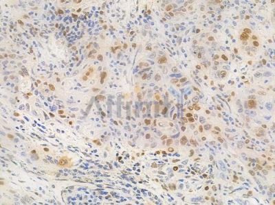SAMHD1 Antibody - DF2987 at 1/100 staining human esophageal carcinoma by IHC-P.