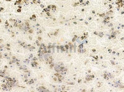 Phospho-PPP1CA (Thr320) Antibody - DF2990 at 1/100 staining human melanoma by IHC-P.
