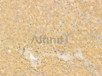 BCKD Antibody - DF3013 at 1/100 staining human hepatocellular carcinoma by IHC-P.