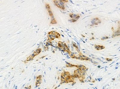 KLF11 Antibody - DF3014 at 1/100 staining human pancreatic carcinoma by IHC-P.
