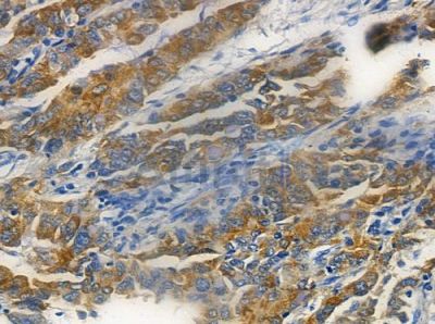 ANP32C Antibody - DF3021 at 1/100 staining human lung adenocarcinoma by IHC-P.