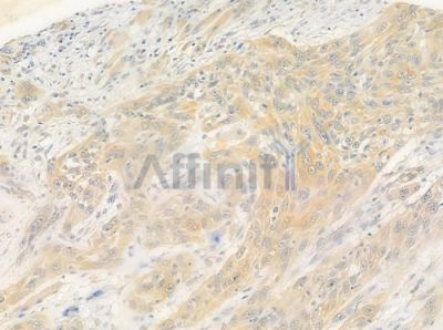 TRIM3 Antibody - DF3040 at 1/100 staining human tongue carcinoma by IHC-P.
