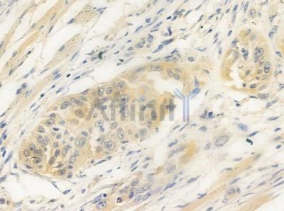 ZNF265 Antibody - DF3054 at 1/100 staining human tongue carcinoma by IHC-P.