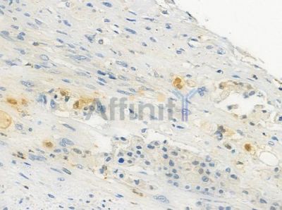 ZNF682 Antibody - DF3062 at 1/100 staining human lung squamous cell carcinoma by IHC-P.