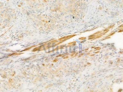 CKMT2 Antibody - DF3104 at 1/100 staining human tongue carcinoma by IHC-P.