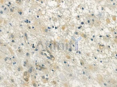 TFEB Antibody - DF3113 at 1/100 staining human astrocytoma by IHC-P.