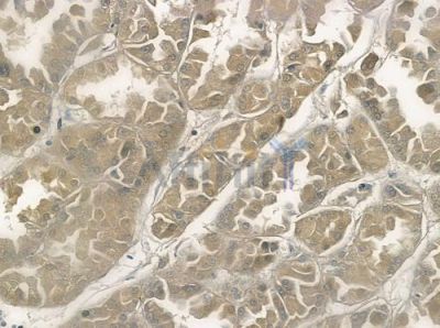 PTTG Antibody - DF3213 at 1/100 staining human renal cell carcinoma by IHC-P.