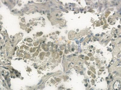 SSBP2 Antibody - DF3228 at 1/100 staining human lung squamous cell carcinoma by IHC-P.