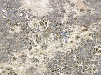 MtSSB Antibody - DF3240 at 1/100 staining human melanoma by IHC-P.