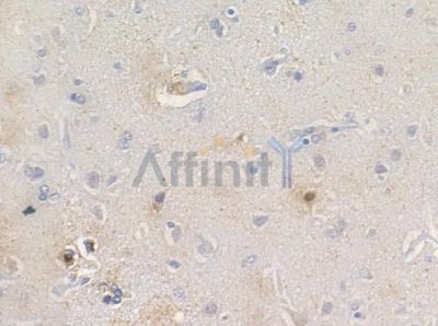 FOXL1 Antibody - DF3253 at 1/100 staining human glioblastoma by IHC-P.