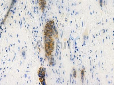 TF2H2 Antibody - DF3272 at 1/100 staining human pancreatic carcinoma by IHC-P.