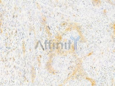 GCKR Antibody - DF3277 at 1/100 staining human tongue carcinoma by IHC-P.