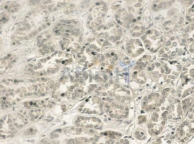 TRAP220/MED1 Antibody - DF3294 at 1/100 staining human renal cell carcinoma by IHC-P.