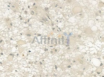 TRAP220/MED1 Antibody - DF3294 at 1/100 staining human astrocytoma by IHC-P.