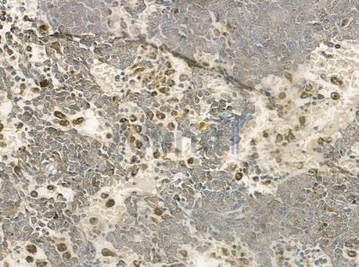 RhoH Antibody - DF3296 at 1/100 staining human melanoma by IHC-P.
