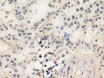 NAB2 Antibody - DF3298 at 1/100 staining human Hodgkin lymphoma by IHC-P.