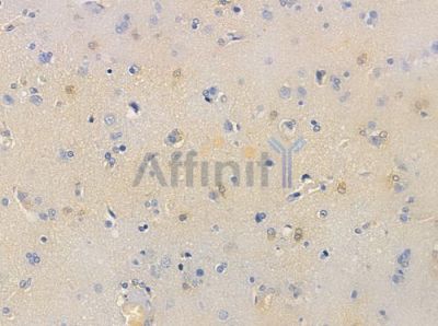 ZNF187 Antibody - DF3305 at 1/100 staining human glioblastoma by IHC-P.