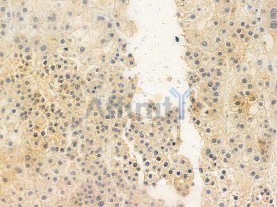PFKFB1/4 Antibody - DF3307 at 1/100 staining human hepatocellular carcinoma by IHC-P.