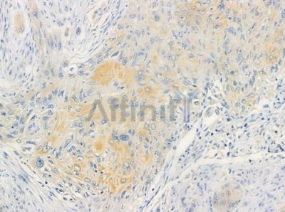 DOK7 Antibody - DF3308 at 1/100 staining human tongue carcinoma by IHC-P.