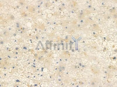 DOK7 Antibody - DF3308 at 1/100 staining human astrocytoma by IHC-P.