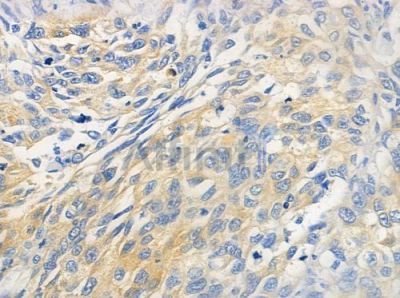 LDOC1L Antibody - DF3323 at 1/100 staining human lung squamous cell carcinoma by IHC-P.